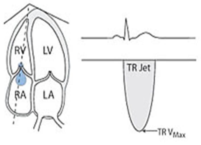 values. Estimated right atrial pressure (RAP) must be added to this obtained value. TR Max Jet Velocity (V) (Figure 9). Right Atrial Pressure (RAP) RVSP=4 (V) 2 + RAP Figure 9: TR jet velocity.