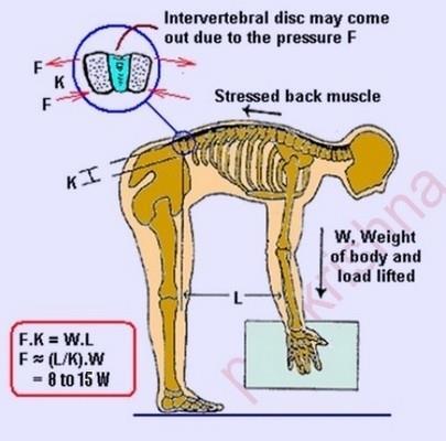 More Biomechanics In this position, to lift a weight of 25 kg creates