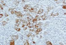 lymphoma, diffuse large B-cell lymphoma CD19 GR014