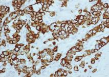 Cell Lymphoma or Breast Cancer Cytokeratin AE1/AE3