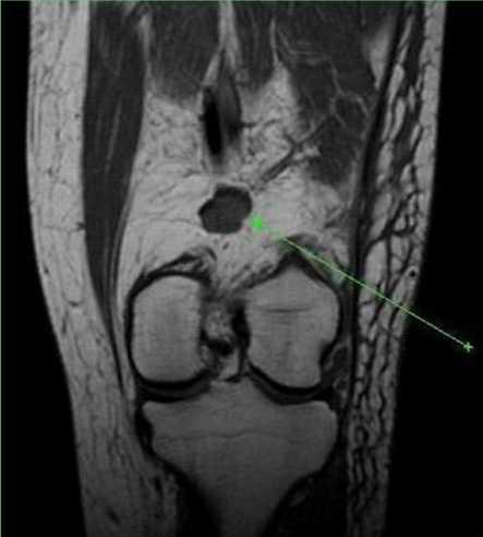 CT scan mass (57x45x27mm) lateral to the patella, containing calcifications same density as the patellar cartilage not