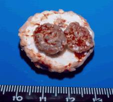 Aspergilloma Colonise pre-existing cavities May be