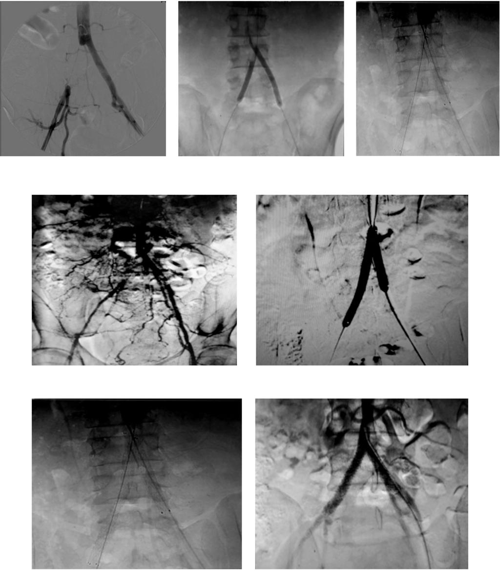 176 Kissing Stents in Treatment of Chronic Total Occlusion (CTO) Fig. (6): Steps of combined bilateral retrograde femoral approach in unilateral right CIA occlusion. Fig. (7-A): Bilateral retrograde femoral approach in bilateral CIA occlusion (Before).