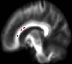 NeuroImage, 2008; 41:1067-1074 NEUROIMAGING STUDIES WITH ADOLESCENTS fmri Studies Differences in levels of activation of hippocampus (memory) compared with controls* Functional connectivity studies