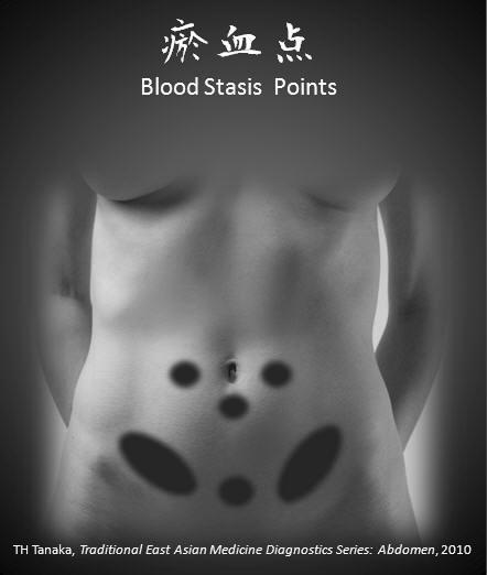 BLOOD STASIS AREAS 癒 血點 YU XUE DIAN Terasawa Okestu point Tenderness around the umbilicus This area is crowded with microcirculation vessels such as small intestine, mesentary and caul.