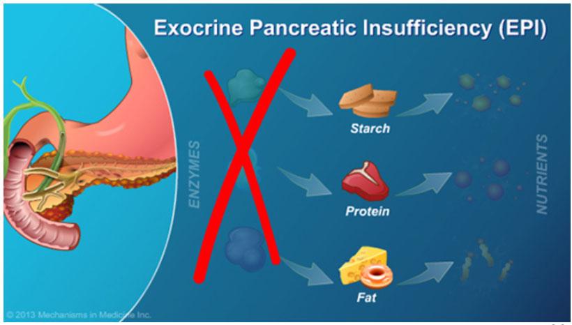 Exocrine pancreas makes enzymes to digest food Hormones messengers Lack of nutrients for our body Can cause