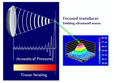 Principles of HIFU Emit High Intensity Focuse d Ultrasound (HIFU) Induce Vibration among the tissue