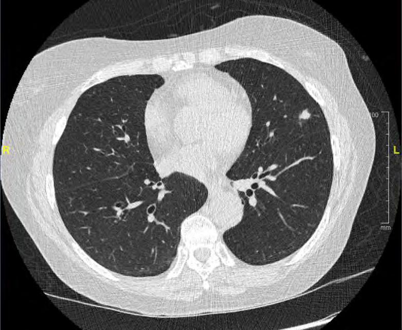 Results of UIC Lung Cancer