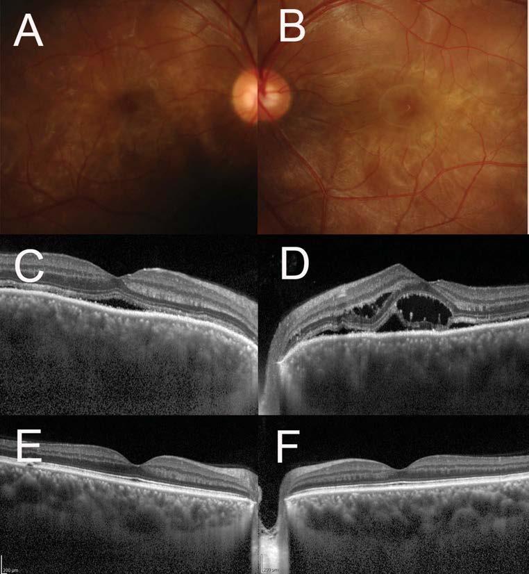 420 RETINA, THE JOURNAL OF RETINAL AND VITREOUS DISEASES 2016 VOLUME 36 NUMBER 2 Fig. 3. A 39-year-old man with VKH disease.