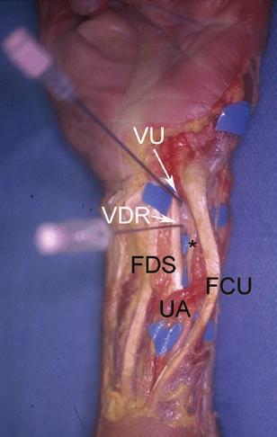 2 Portals and Methodology distal ulnar and volar part of the forearm to a level of 3 cm distal to the wrist crease. Its territory may extend radially beyond the palmaris longus tendon [3].