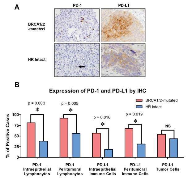 BRCA1/2-mutated HGSOCs may be more sensitive to PD-1/PD-L1 inhibitors compared to HR-proficient HGSOCs BRCA1/2-mutated tumors exhibited: significantly increased CD3+ and CD8+ TILs elevated expression