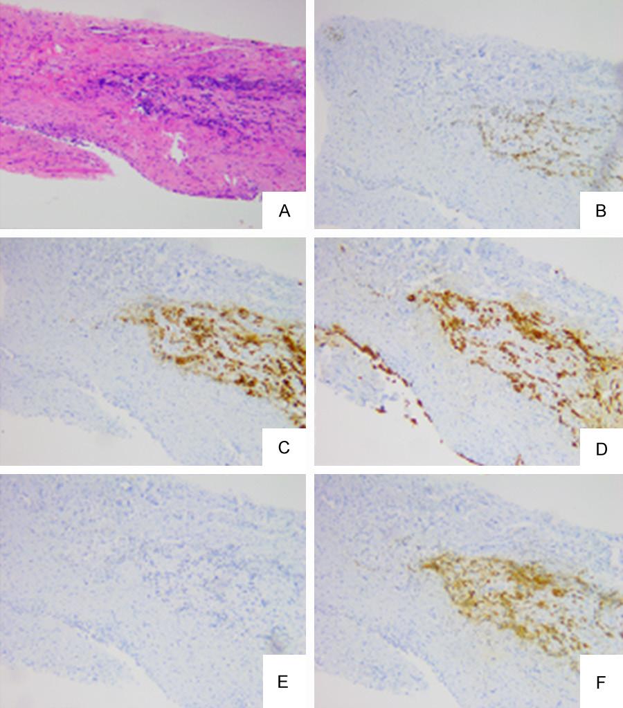 Figure 5. Gastric adenocarcinoma metastatic to the bladder. A.