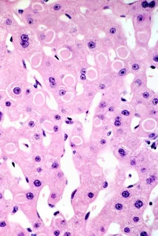 HBV special stains and immunohistochemistry Ground glass hepatocytes contain endoplasmic reticulum full of HBsAg This cytoplasmic appearance can be simulated by: Hepatocyte oncocytosis Drugs: usually