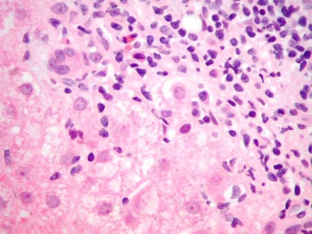 Piecemeal necrosis is characterised by lymphocytic infiltration and destruction of hepatocytes at the connective