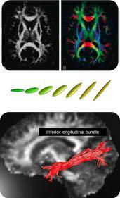 Diffusion tensor imaging (DTI) uses MRI to map the diffusion of water and