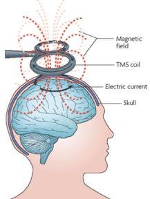 Electromagnetic stimulation can be used to test causal links between regional brain activation and cognition» Direct Cortical Stimulation (DCS) invasive ; indicated before certain medical procedures»