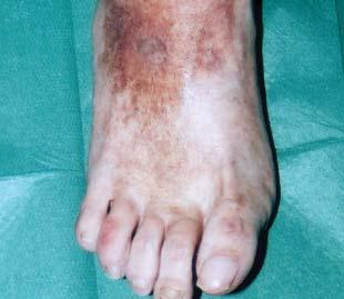 Following debridement the ulcer site was treated with INTRASITE Gel and ACTICOAT 7, whilst the allergic reaction was treated with hydrocortisone 1% ointment.
