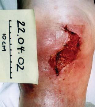 lady who fell in her home in March 2002 and suffered a large wound in the area medial to the kneecap.