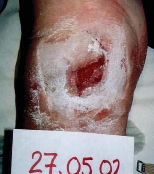 This had been treated with, among other things, skin grafting and treatment was completed on 5 March 2002. The patient was known to have venous insufficiency.