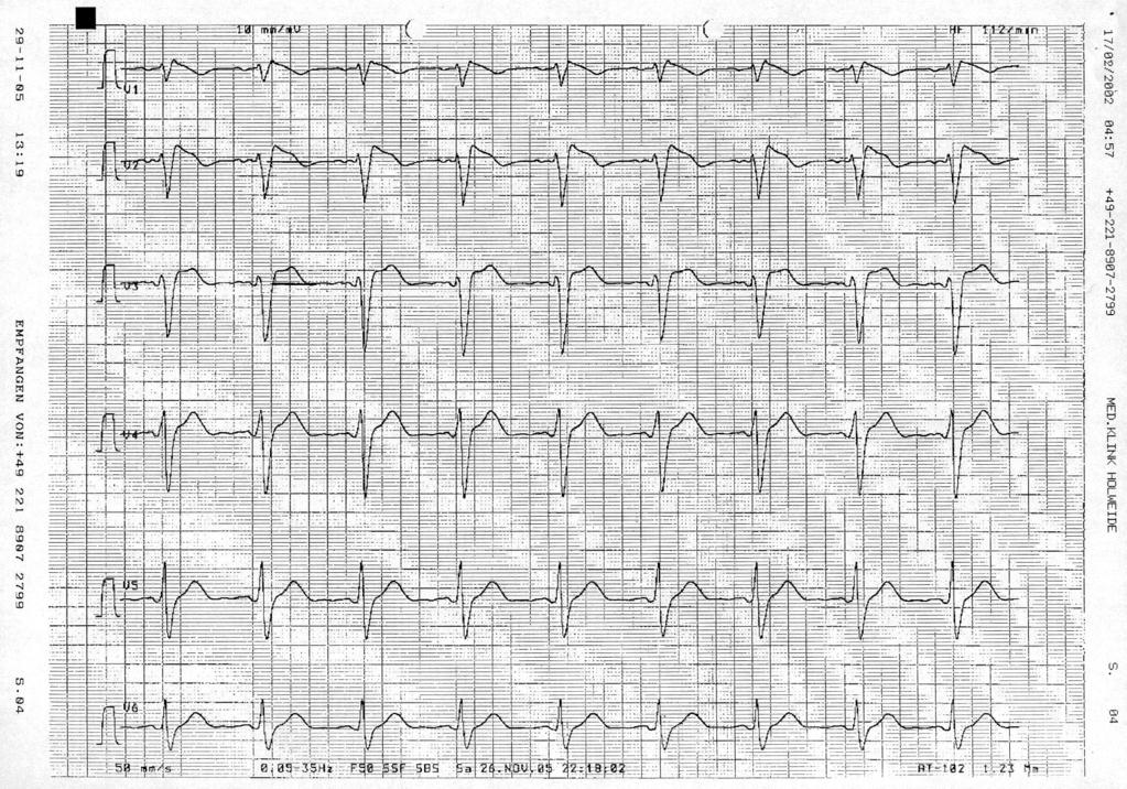 45 yr old male preoperative routine ECG asymptomatic FHx: 1 brother (SCD