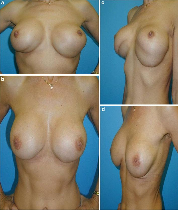 The volume of the implant should be reduced, and it should be ensured that the content is cohesive gel [3, 6, 8]. Double Submammary Fold Fig.