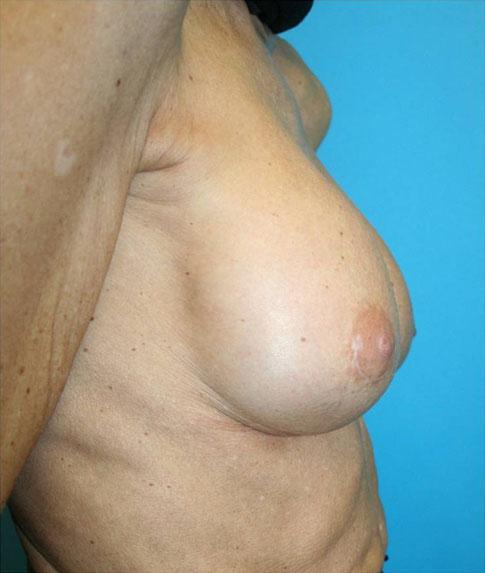 Aesth Plast Surg (2010) 34:691 700 699 surgery, it generally is due to a hematoma and will manifest as pain, hardening of the breast that does not diminish in a few days, and an increase in volume.