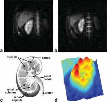 (26) Sodium MRI of the Human Kidney at 3 Tesla 3D gradient-echo sequence using an inhousebuilt quadrature surface