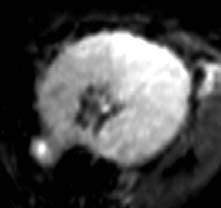 USPIO Imaging of the kidneys Phase II study in 12 patients with renal
