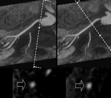 Grading scheme of renal artery stenosis 35 3 grade 1 35 3 grade 2 velocity