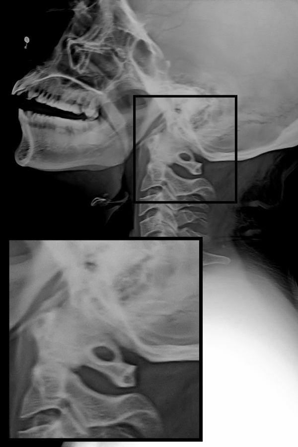 1: Lateral radiograph- Lateral radiograph- Showing normal spine with vertebrae C1-5. Fig. 2: Lateral radiograph-complete. Fig. 3: Lateral radiograph- Incomplete.