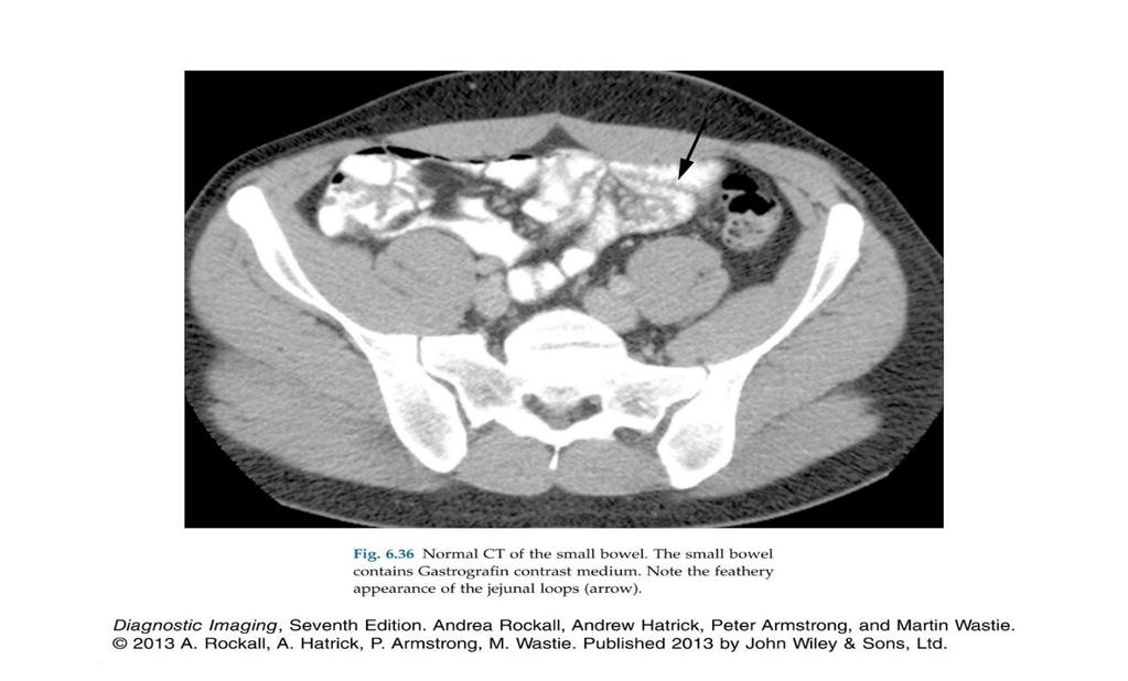 10 Large bowel Young healthy male complaining of right iliac fossa pain with leukocytosis and fever. What is the Diagnosis? Appendicitis.