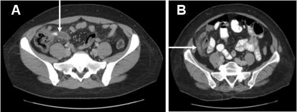 CT scan showing Normal appendix Blind ended tube in right iliac fossa. could present with white spot. Enlarged appendix measures more than 6mm.