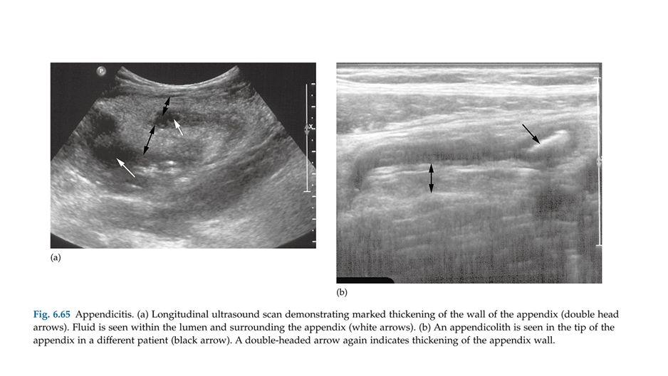 !! Appendicitis In US there is thickening of the wall (double headed arrow) and we can see appendicolith in the tip of the appendix (single headed arrow).