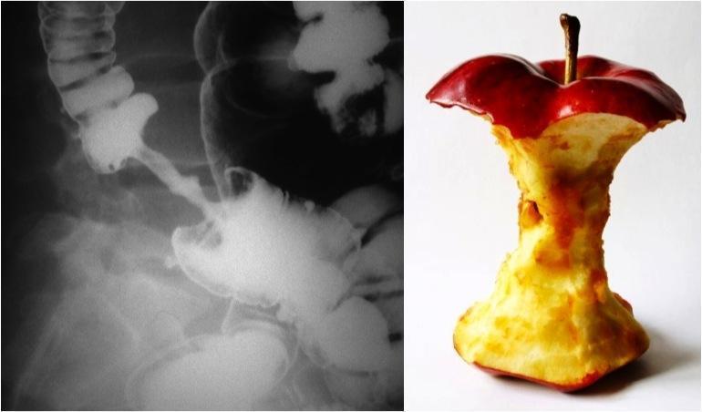 Barium enema (left image) shows narrowing of the lumen due to presence of soft tissue mass Apple core sign = (narrowing +