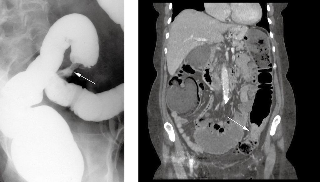 Colon carcinoma standard axial CT acquired on thin sections showing a tumor in the transverse colon.