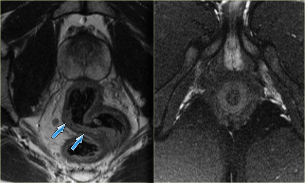 Note the mesorectal fascia (black arrows) encases the mesorectal fat and the rectum. Posterior wall of the rectum is normal and in the lumen there is gas.