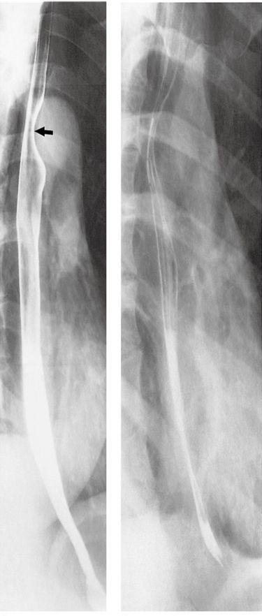 Imaging modalities: X-ray. Fluoroscopy (contrast study) 1st choice (Barium swallow = shows us the lumen and mucosal lining ) we do not use it if we suspect perforation.
