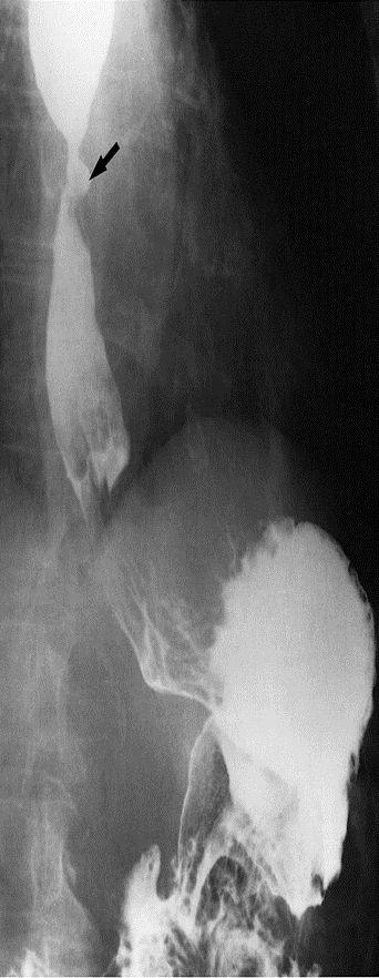 Rat tail and bird beak sign with no shouldering > benign 2 Corrosive Stricture Irregular narrowing in the whole esophagus with dilated inflow.