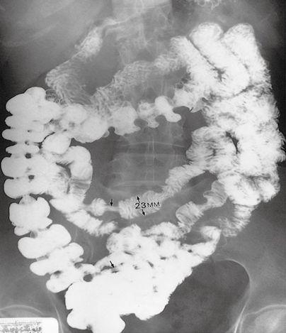 6 Small bowel Clinical signs and symptoms: Malabsorption. Vomiting. Diarrhea. Age (some diseases related to specific age).