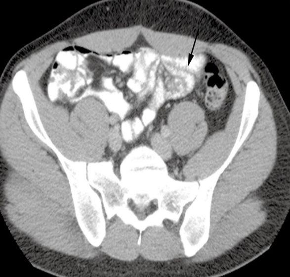 The arrows point to a portion of bowel which is particularly involved by lymphoma. Lumen surroundings are clear in CT.