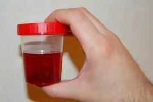 Red urine is not