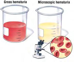 urine) Microscopic Hematuria >3RBCs/HPF from 2 of 3