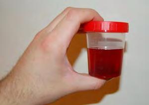 If the amount of blood in urine is big