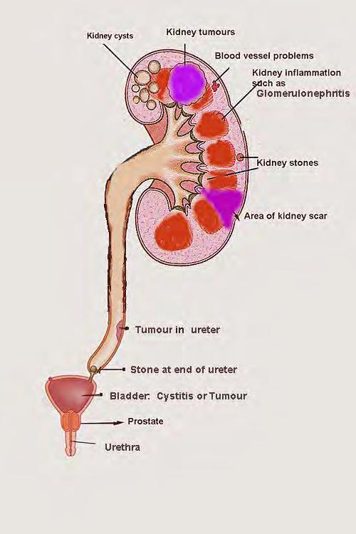 Hematuria may originate from different sites in the urinary