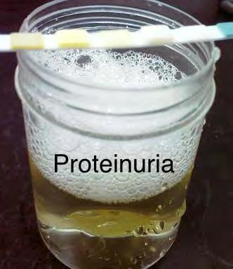 Proteinuria indicates the