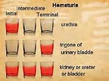 Initial hematuria, at the onset of urination= urethra.