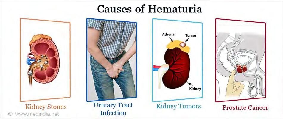 The causes of hematuria range from vigorous exercise, to the more serious causes