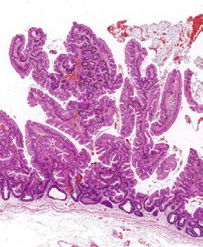 A subset of colorectal polyps are