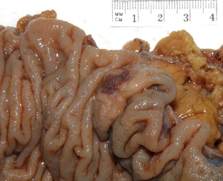 Sessile Serrated Adenoma with
