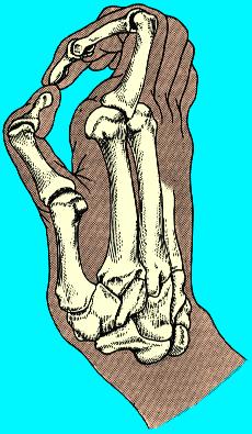 Clinical picture Ulnar